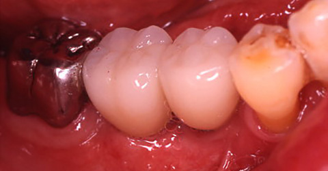 治療例１　奥歯の治療例