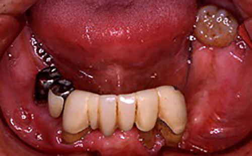 治療例２　下の歯の治療例