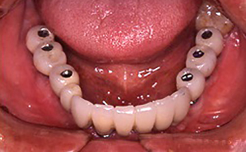 治療例２　下の歯の治療例