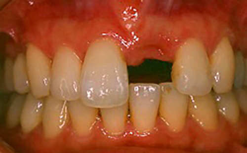 治療例３　前歯の治療例