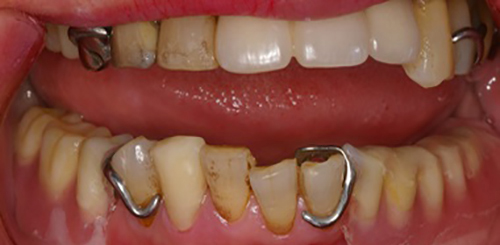 治療例1　バネが目立たない義歯