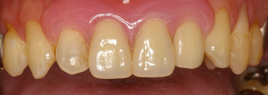 治療例6　バネの無い義歯