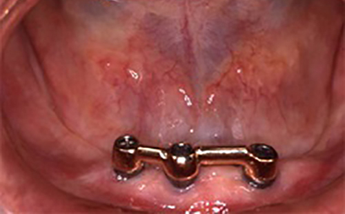 治療例５　義歯を支えるインプラント