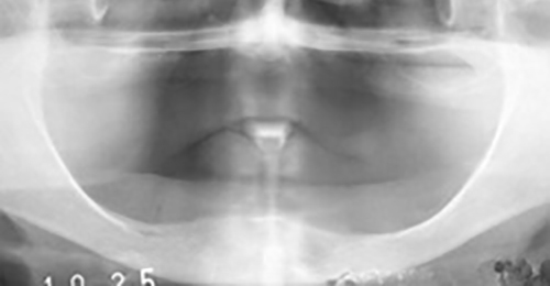 治療例５　義歯を支えるインプラント