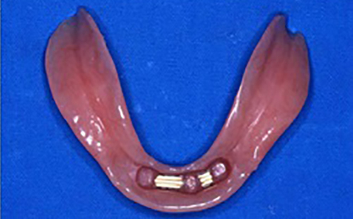 義歯の裏側　