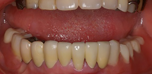 治療例1　バネが目立たない義歯