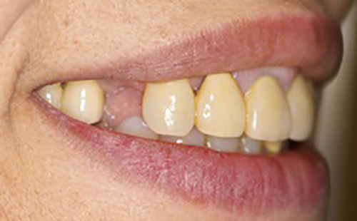 治療例３　バネの無い義歯
