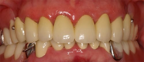 治療例2　バネが目立たない義歯