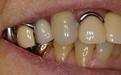 治療例4　バネの無い義歯