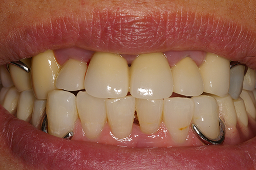 治療例5　バネの無い義歯
